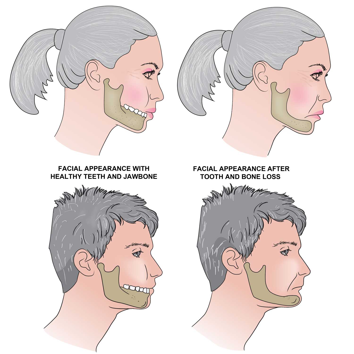 facial-collapse-after-tooth-bone-lose-before-after