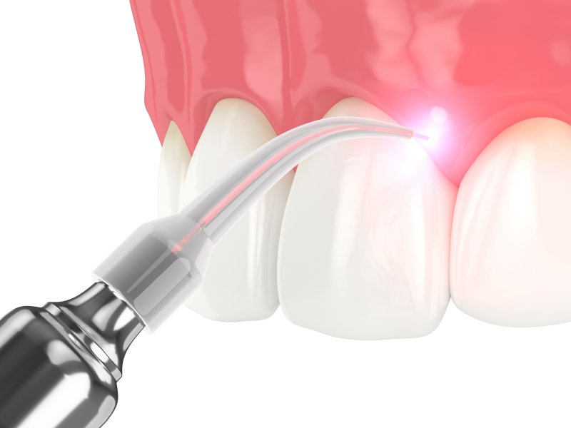 Dental Laser