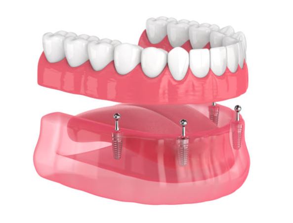 implant dentures